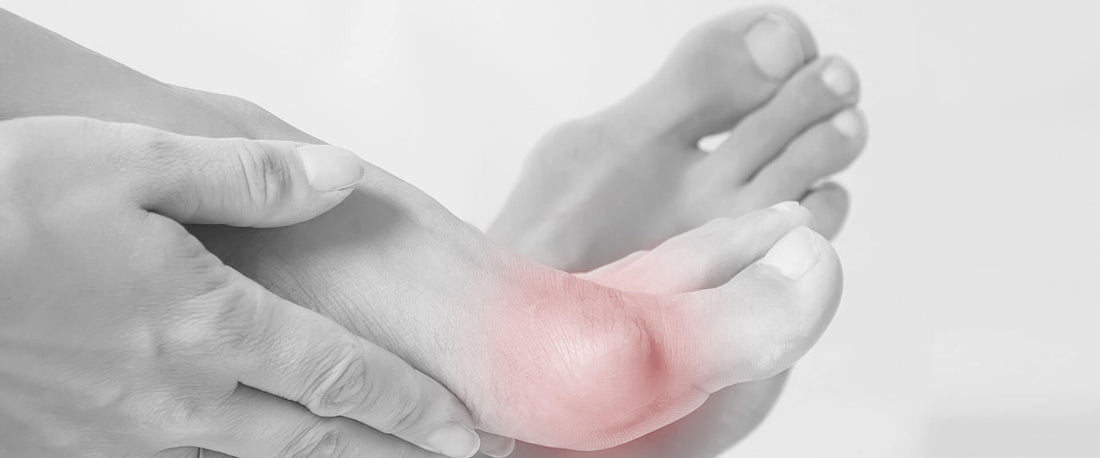 ¡Qué sí y que no para disminuir los juanetes!