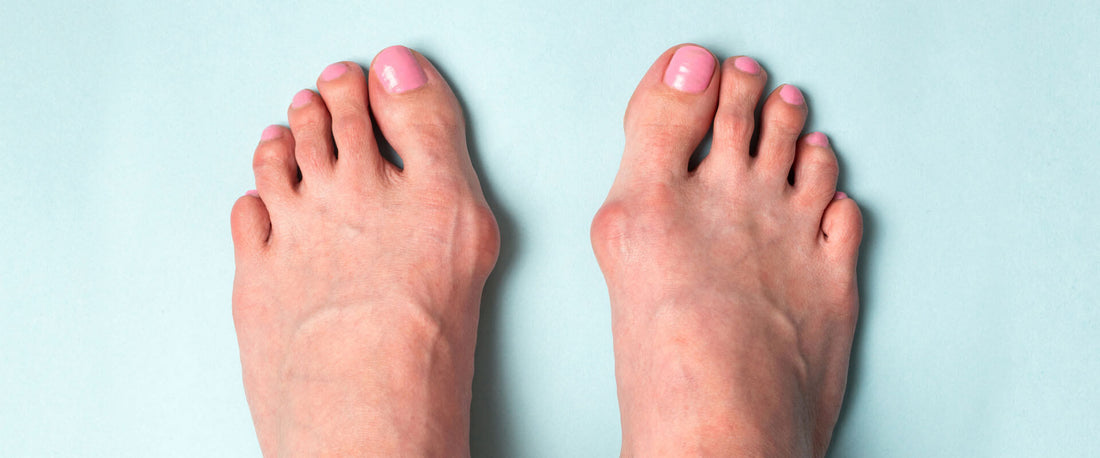 ¿Dolor en el dedo gordo del pie? Puede ser un juanete