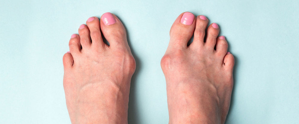 ¿Dolor en el dedo gordo del pie? Puede ser un juanete-Salud Bienestar